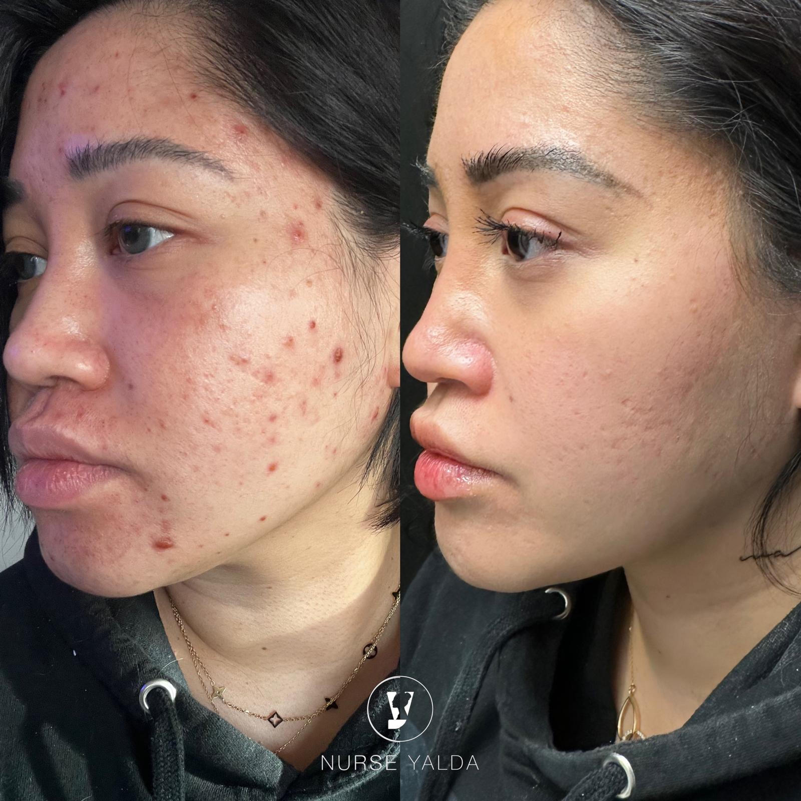 Acne Scar Treatment - Rejuvenation Clinic - Vienna Med Spa