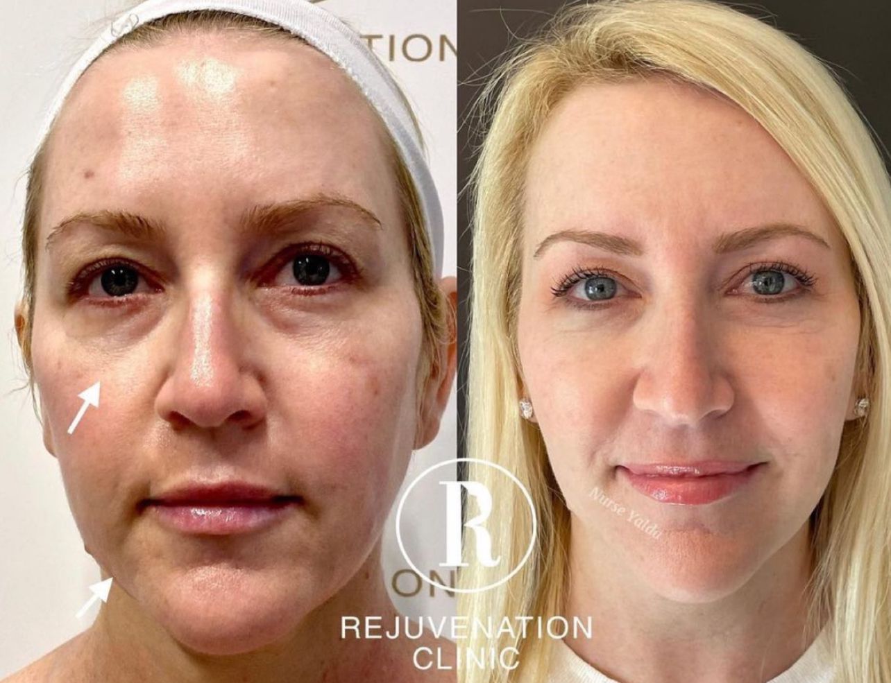 Microneedling with PRF & PRP - Rejuvenation Clinic - Vienna Med Spa