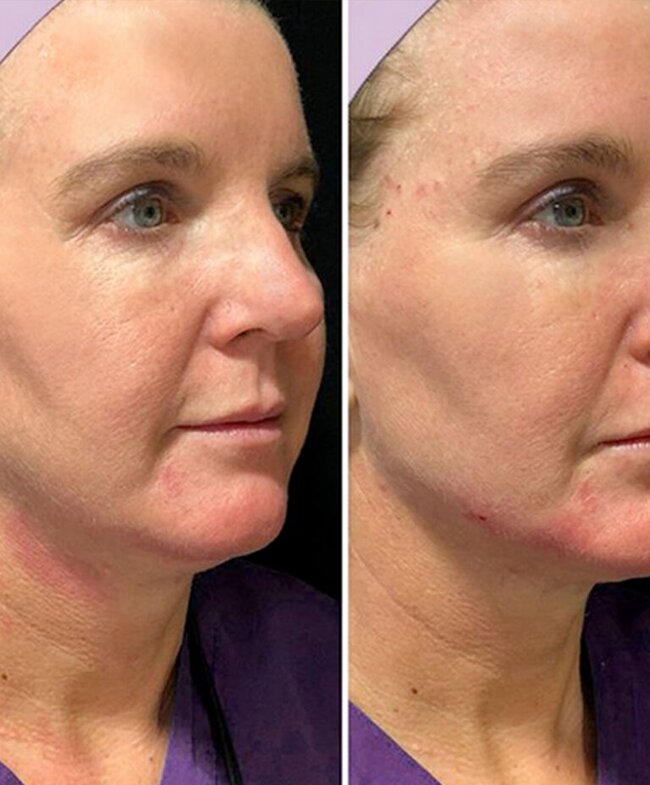 Renuva - Rejuvenation Clinic - Vienna Med Spa