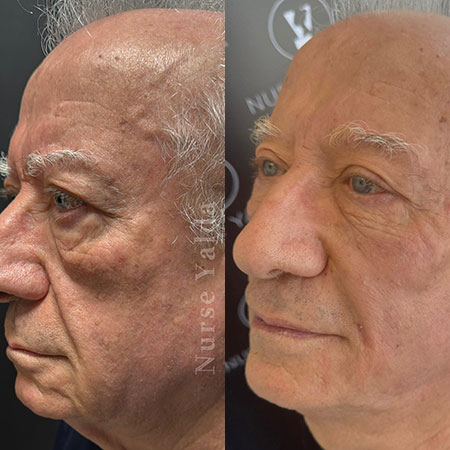 Dermal Fillers- Rejuvenation Clinic - Vienna Med Spa