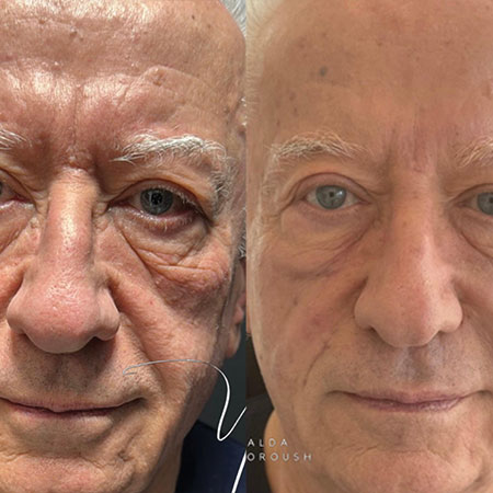 Dermal Fillers- Rejuvenation Clinic - Vienna Med Spa