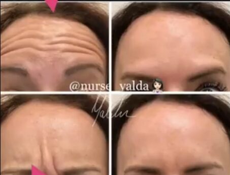 Botox Before and After - Rejuvenation Clinic - Vienna Med Spa