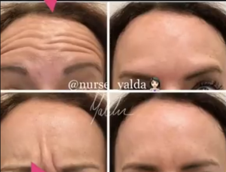 Botox Before and After - Rejuvenation Clinic - Vienna Med Spa