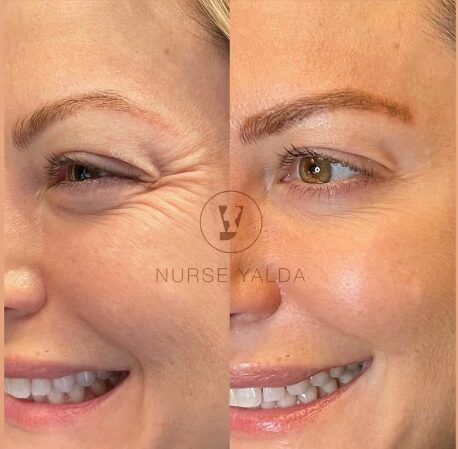 Botox Before and After - Rejuvenation Clinic - Vienna Med Spa