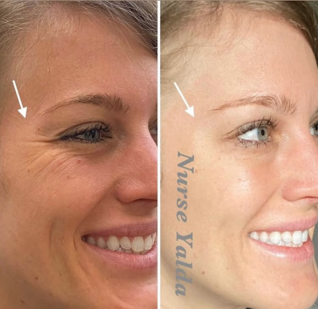 Botox Before and After - Rejuvenation Clinic - Vienna Med Spa