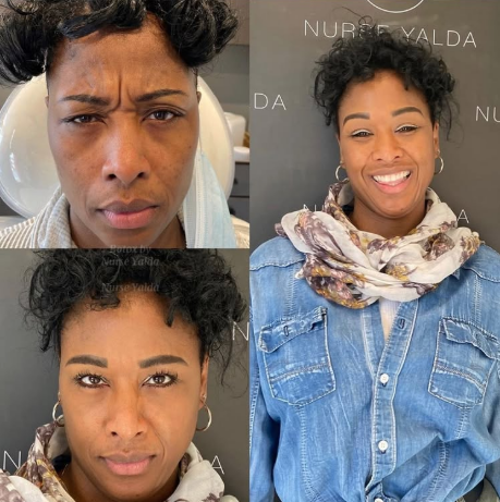 Botox Before and After - Rejuvenation Clinic - Vienna Med Spa