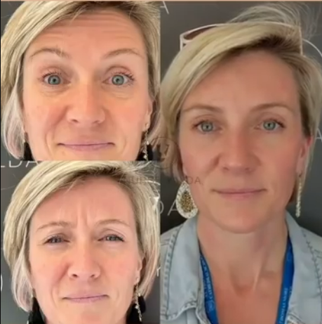 Botox Before and After - Rejuvenation Clinic - Vienna Med Spa