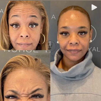 Botox Before and After - Rejuvenation Clinic - Vienna Med Spa