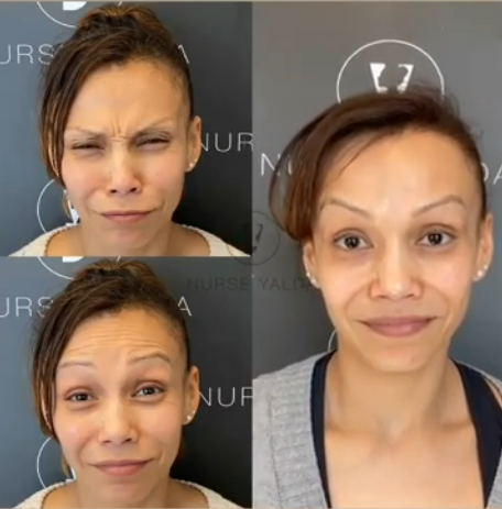 Botox Before and After - Rejuvenation Clinic - Vienna Med Spa