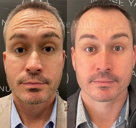 Botox Before and After - Rejuvenation Clinic - Vienna Med Spa