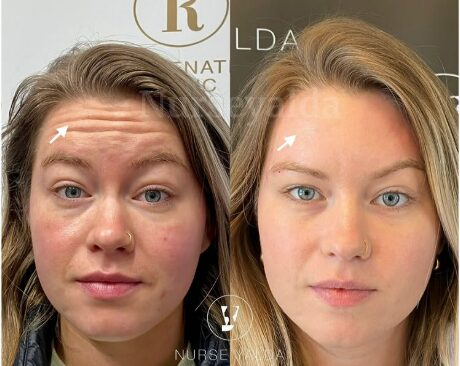 Botox Before and After - Rejuvenation Clinic - Vienna Med Spa
