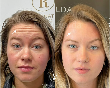 Botox Before and After - Rejuvenation Clinic - Vienna Med Spa