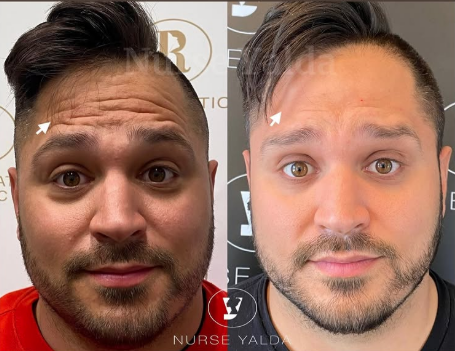 Botox Before and After - Rejuvenation Clinic - Vienna Med Spa