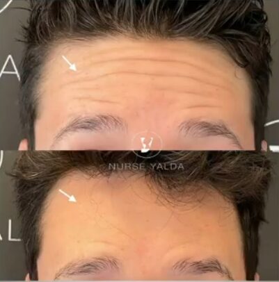 Botox Before and After - Rejuvenation Clinic - Vienna Med Spa