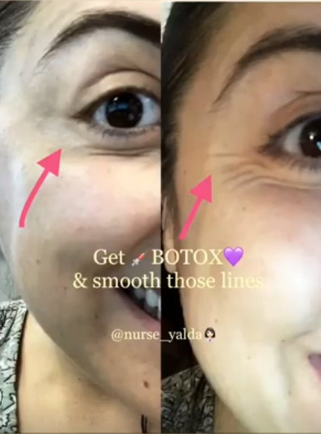 Botox Before and After - Rejuvenation Clinic - Vienna Med Spa
