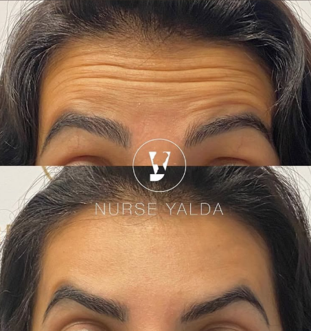 Botox Before and After - Rejuvenation Clinic - Vienna Med Spa