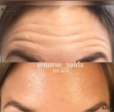 Botox Before and After - Rejuvenation Clinic - Vienna Med Spa