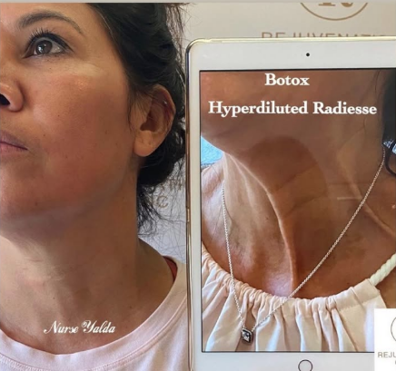 Botox Before and After - Rejuvenation Clinic - Vienna Med Spa