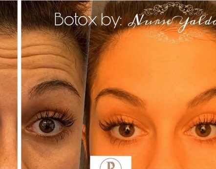 Botox Before and After - Rejuvenation Clinic - Vienna Med Spa