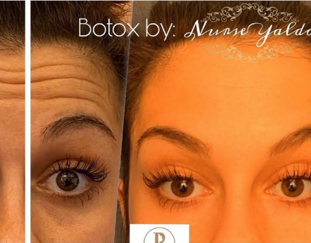 Botox Before and After - Rejuvenation Clinic - Vienna Med Spa