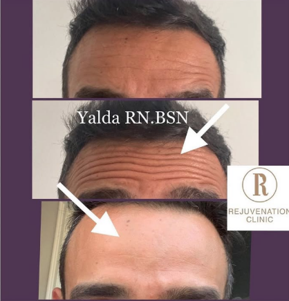 Botox Before and After - Rejuvenation Clinic - Vienna Med Spa