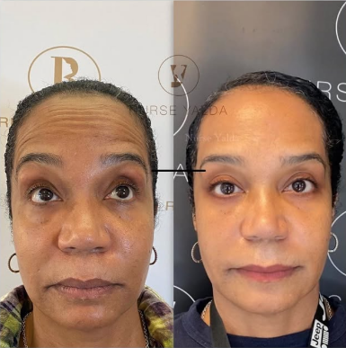 Botox Before and After - Rejuvenation Clinic - Vienna Med Spa