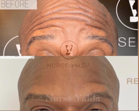 Botox Before and After - Rejuvenation Clinic - Vienna Med Spa