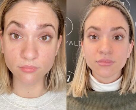 Botox Before and After - Rejuvenation Clinic - Vienna Med Spa
