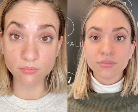 Botox Before and After - Rejuvenation Clinic - Vienna Med Spa