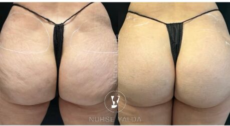 Buttocks Enhancement Before and After - Rejuvenation Clinic - Vienna Med Spa
