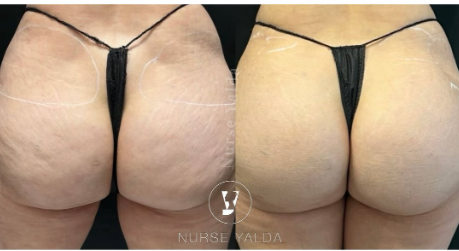 Buttocks Enhancement