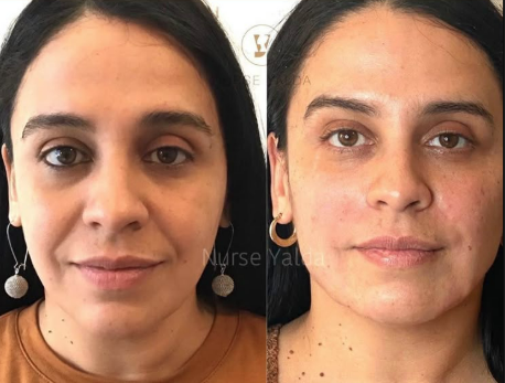 Dermal Fillers - Rejuvenation Clinic - Vienna Med Spa