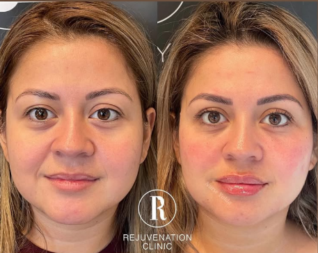 Dermal Fillers - Rejuvenation Clinic - Vienna Med Spa