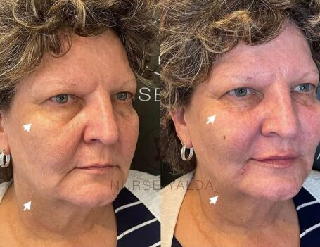 Dermal Fillers - Rejuvenation Clinic - Vienna Med Spa