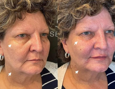 Dermal Fillers - Rejuvenation Clinic - Vienna Med Spa