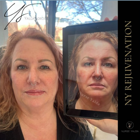 Dermal Fillers - Rejuvenation Clinic - Vienna Med Spa