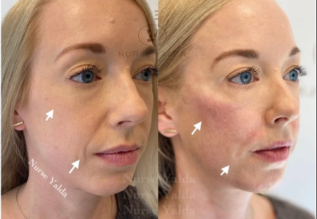 Dermal Fillers - Rejuvenation Clinic - Vienna Med Spa