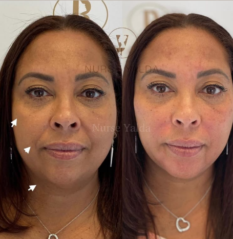 Dermal Fillers - Rejuvenation Clinic - Vienna Med Spa