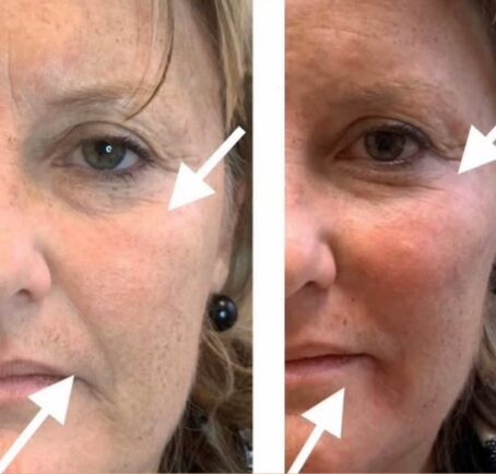 Dermal Fillers - Rejuvenation Clinic - Vienna Med Spa
