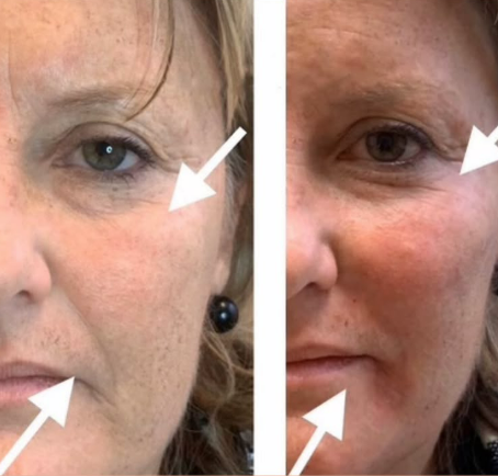 Dermal Fillers - Rejuvenation Clinic - Vienna Med Spa