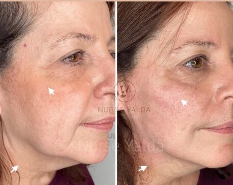 Dermal Fillers - Rejuvenation Clinic - Vienna Med Spa