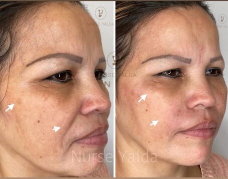 Dermal Fillers - Rejuvenation Clinic - Vienna Med Spa