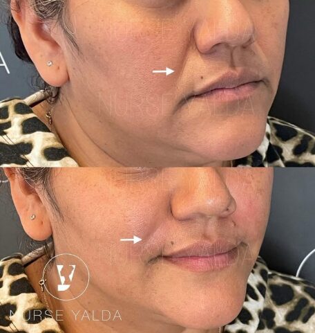 Dermal Fillers - Rejuvenation Clinic - Vienna Med Spa