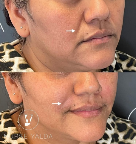 Dermal Fillers - Rejuvenation Clinic - Vienna Med Spa