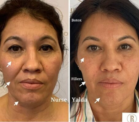 Dermal Fillers - Rejuvenation Clinic - Vienna Med Spa