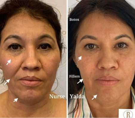 Dermal Fillers - Rejuvenation Clinic - Vienna Med Spa