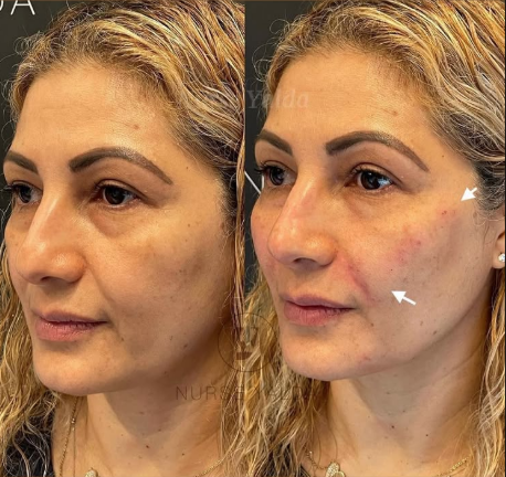 Dermal Fillers - Rejuvenation Clinic - Vienna Med Spa