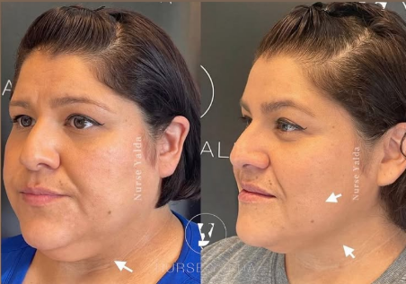 Kybella - Rejuvenation Clinic - Vienna Med Spa