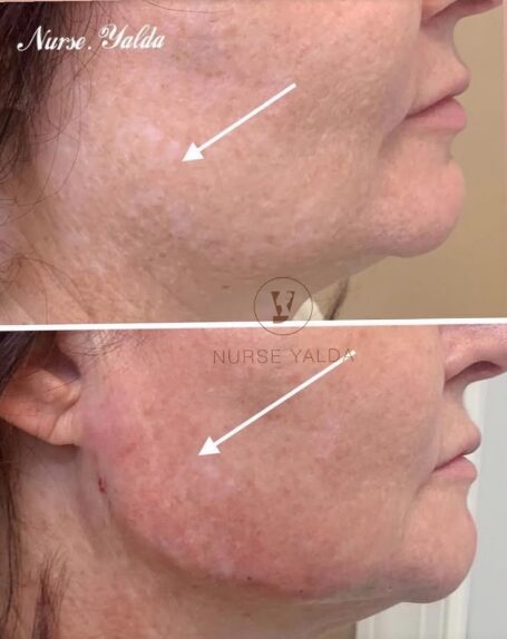 Kybella - Rejuvenation Clinic - Vienna Med Spa