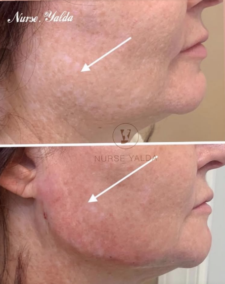 Kybella - Rejuvenation Clinic - Vienna Med Spa